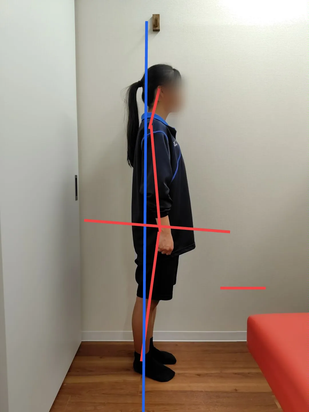 歩き方と姿勢の悪さで通院された中学生の子の2か月後の変化を解説