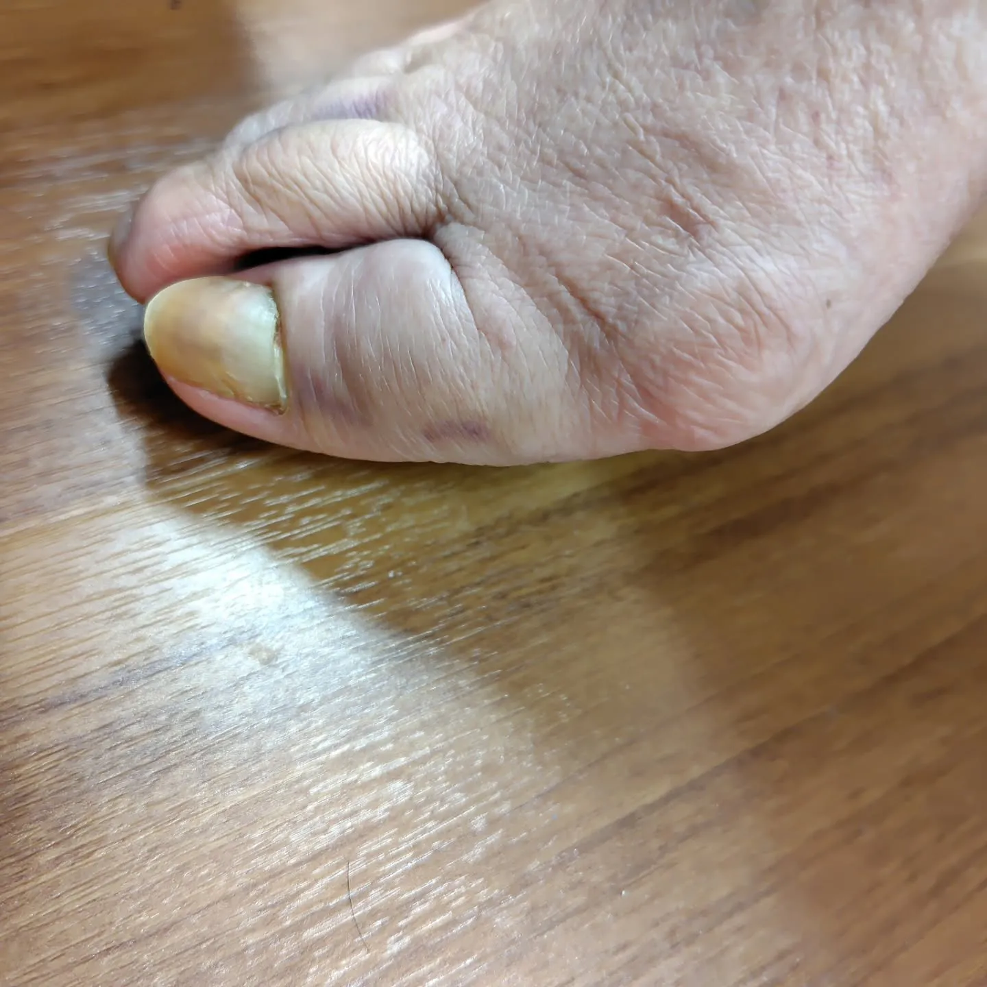 立ち上がる時に転倒してしまい右足を痛めてしまった方に、早期回...