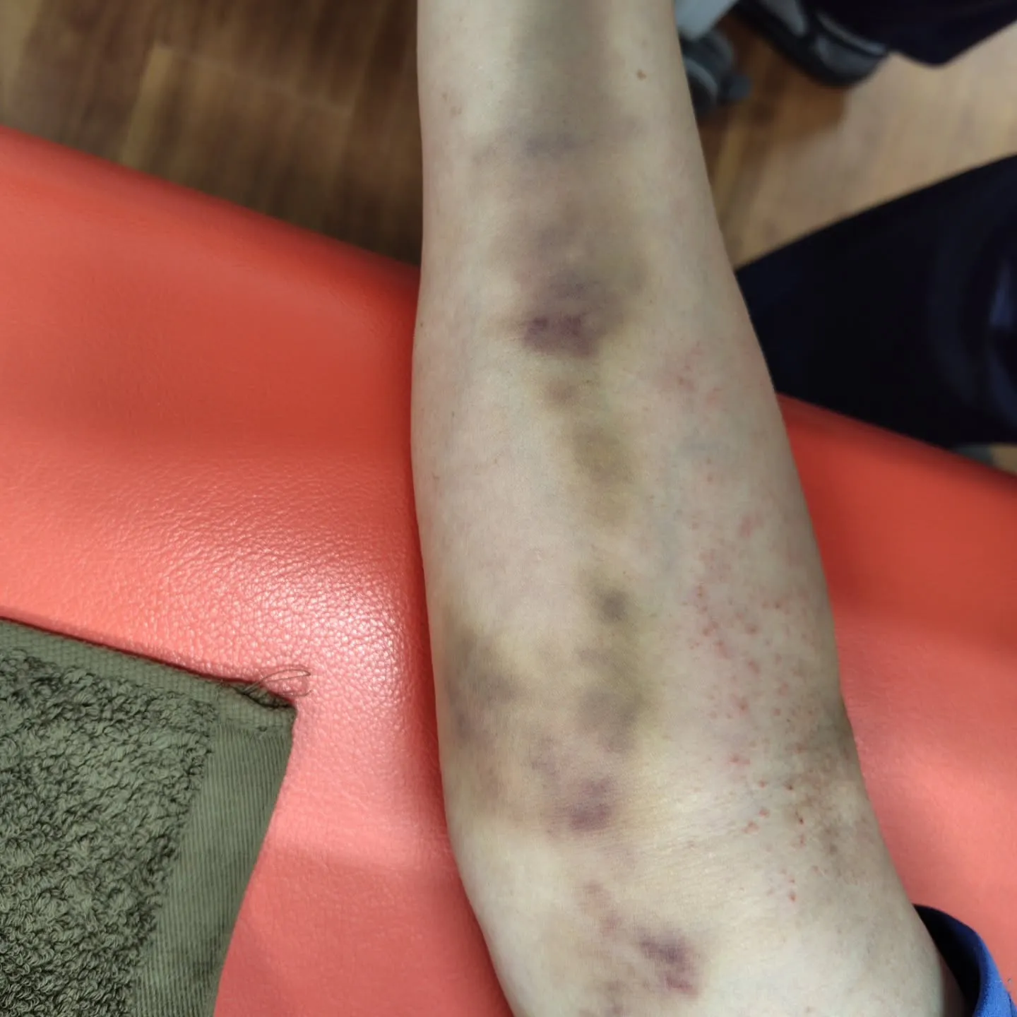 歩いている時に溝に足を取られて転倒してしまい、右肘と左手首の...