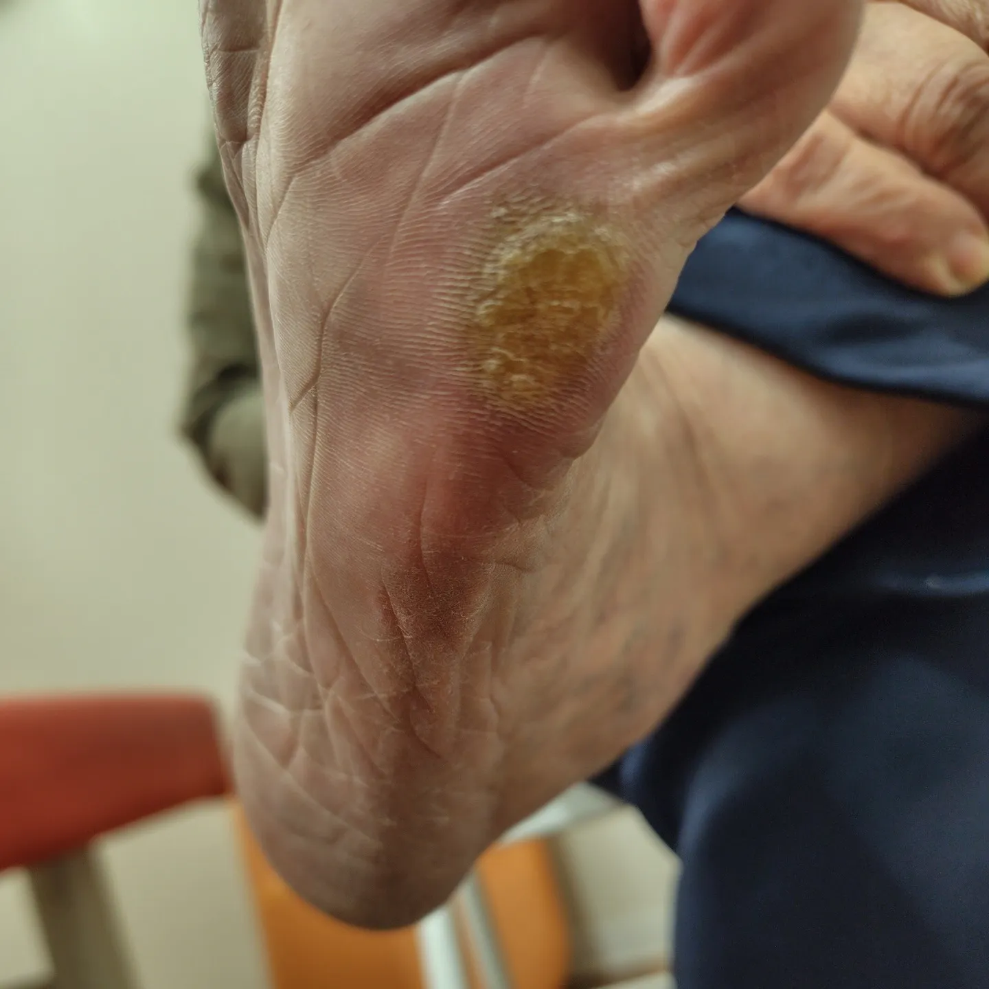 膝の痛みでお悩みの方に足部チェックとインソールに乗った時の評...