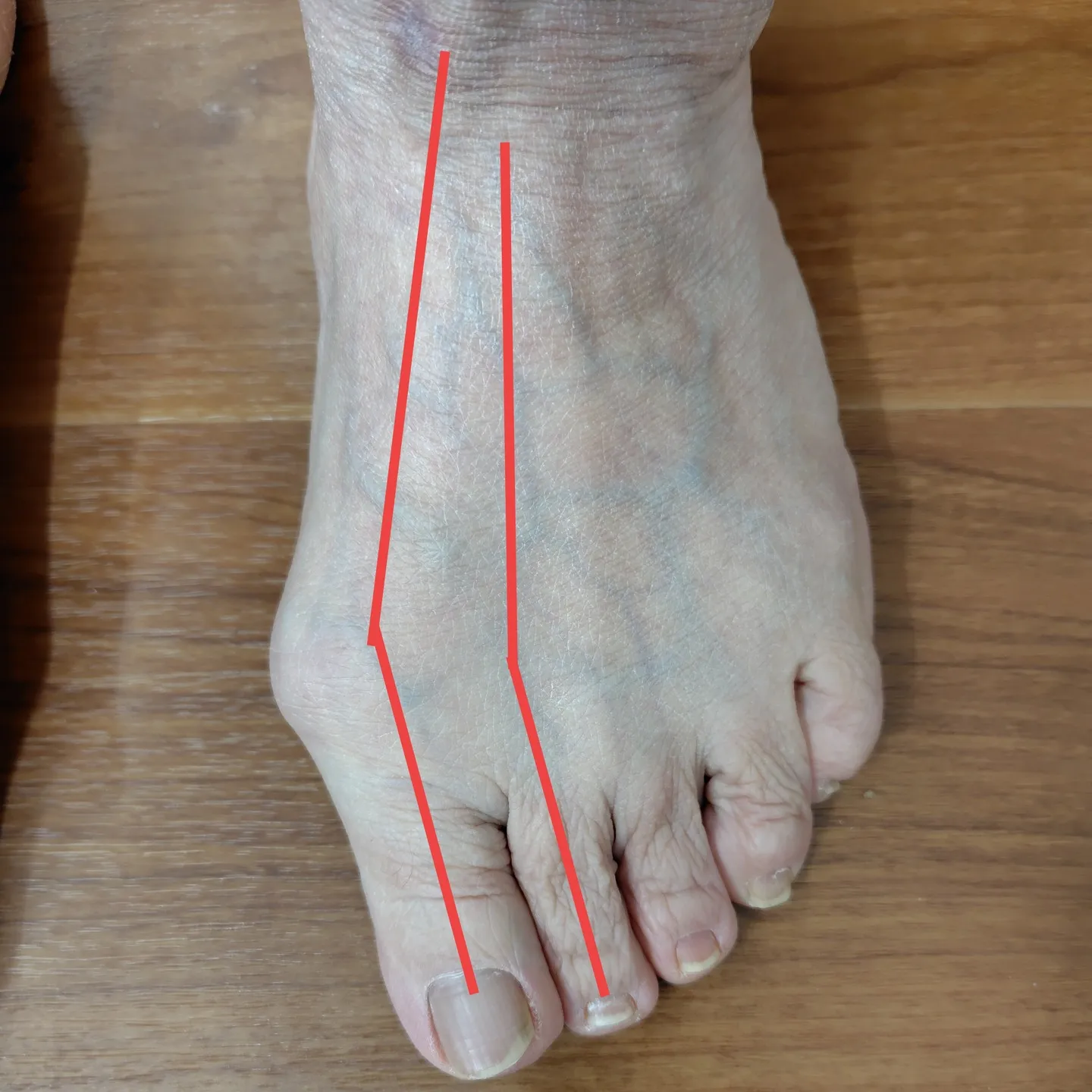 膝の痛みでお悩みの方に足部チェックとインソールに乗った時の評...