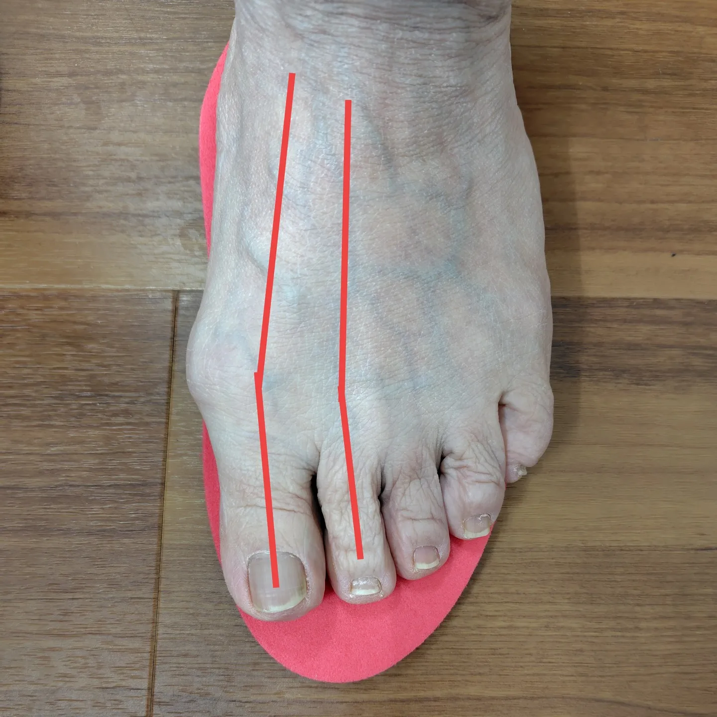 膝の痛みでお悩みの方に足部チェックとインソールに乗った時の評...